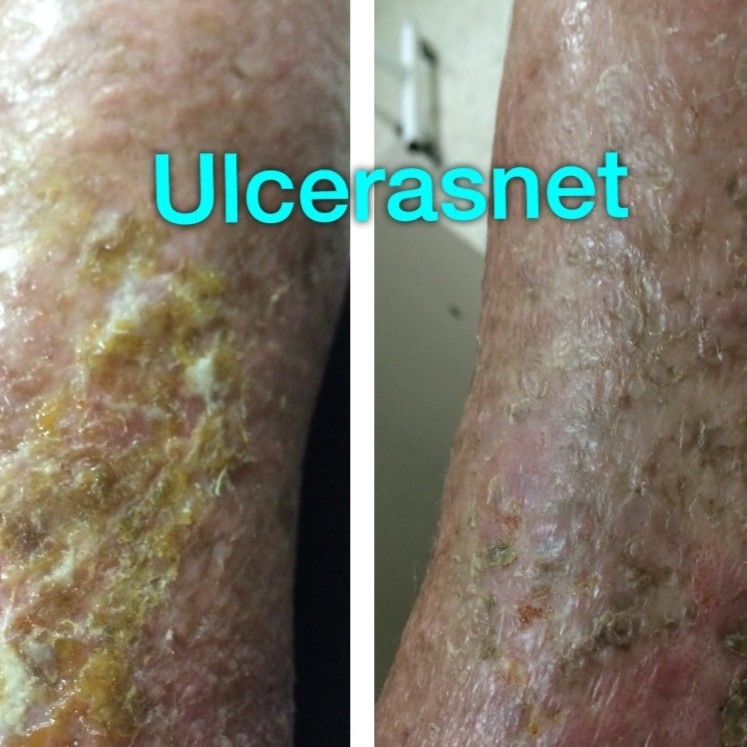 destacados en ulceras.net