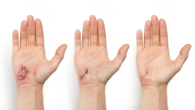 destacados en ulceras.net